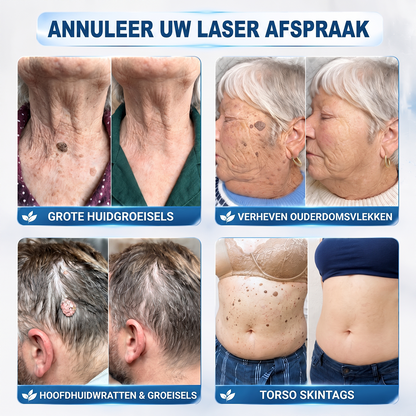 荷) 𝐇𝐈𝐒𝐊𝐈𝐍®👩‍⚕️ 7-daagse huidtag & littekenverwijderaar Pijnloze & littekenvrije geavanceerde rollerballpen voor het verwijderen van onvolkomenheden