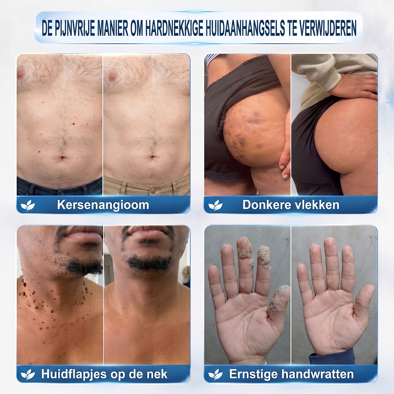 荷) 𝐇𝐈𝐒𝐊𝐈𝐍®👩‍⚕️ 7-daagse huidtag & littekenverwijderaar Pijnloze & littekenvrije geavanceerde rollerballpen voor het verwijderen van onvolkomenheden