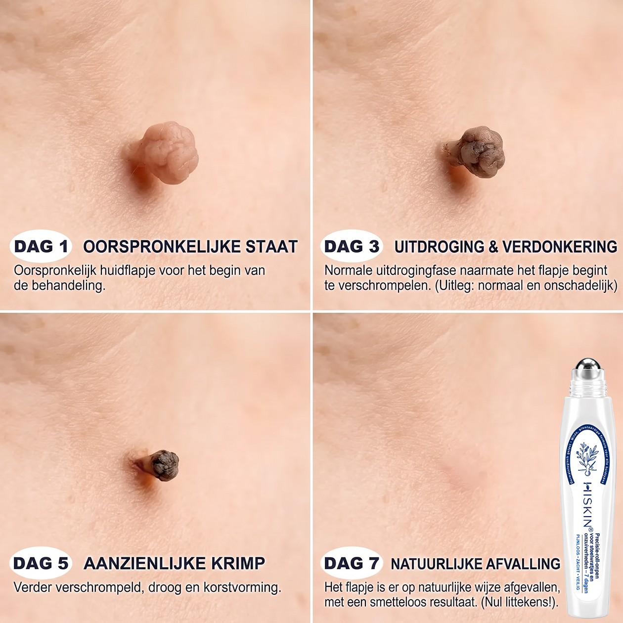 荷) 𝐇𝐈𝐒𝐊𝐈𝐍®👩‍⚕️ 7-daagse huidtag & littekenverwijderaar Pijnloze & littekenvrije geavanceerde rollerballpen voor het verwijderen van onvolkomenheden